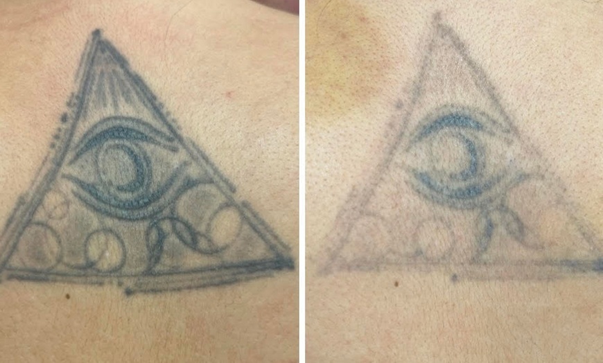 Image 4: 1 or 3 Sessions of Laser Tattoo Removal for XS, Small & Medium Areas