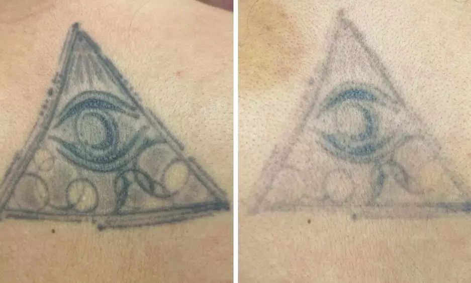 1 or 3 Sessions of Laser Tattoo Removal for XS, Small & Medium Areas