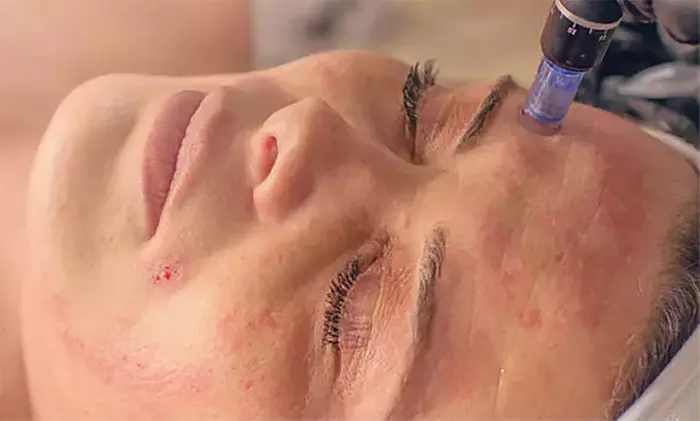 (Up to 40% Off) on RF Microneedling Treatments (Full Face) at Lavande Spa - Second Medium
