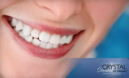 $90 for Take-Home Teeth Whitening at Crystal Dental of Fresno ($500 Value) or $49 for Full Exam, Oral Cancer Screening, X-Rays, and Cleaning ($308 Value) - Primary Image