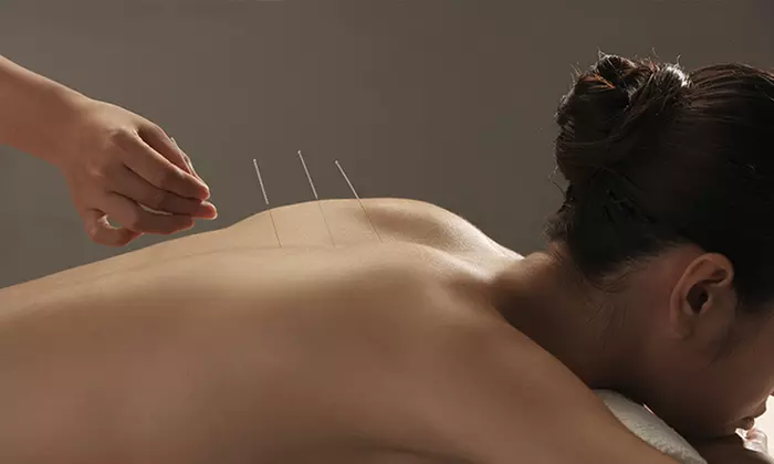 One or Three Acupuncture Sessions at Asula Wellness Center (Up to 66%Off)  - Primary Image