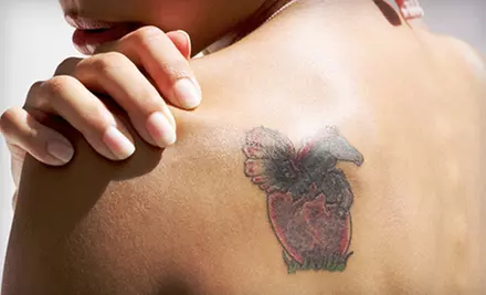 Three Laser Tattoo-Removal Sessions on Up to 3, 6, or 10 Square Inches at InkOff Laser Tattoo Removal (Up to 73% Off) - Primary Image