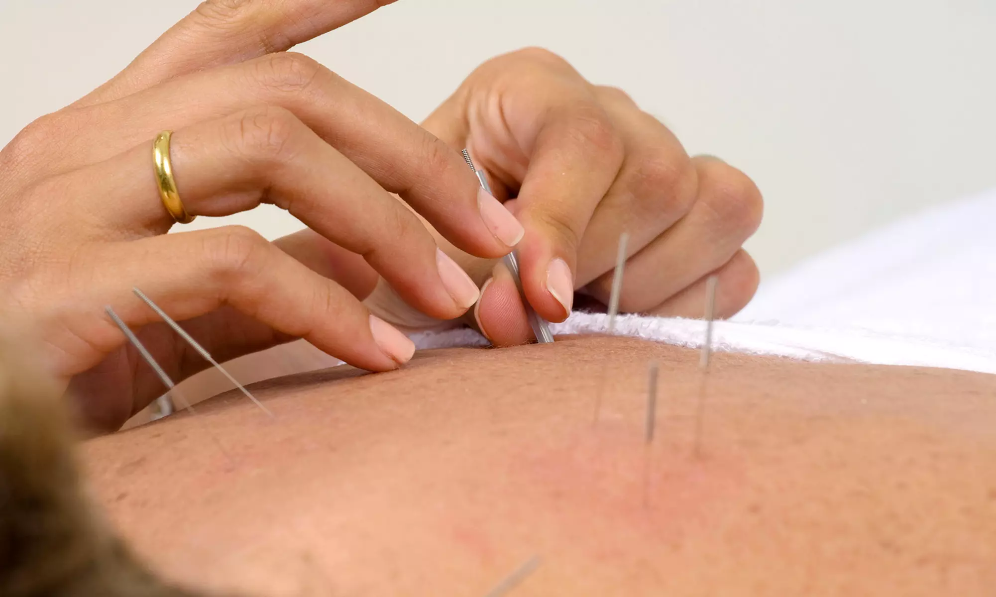 One or Three Acupuncture Sessions with Optional Tui Na at Milwaukee Acupuncture and Wellness, LLC (Up to 69% Off) - Primary Image