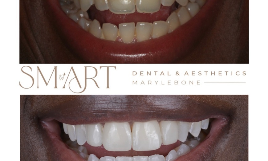 Image 10: Home Teeth Whitening Kit at Smart Dental and Aesthetics Clinic