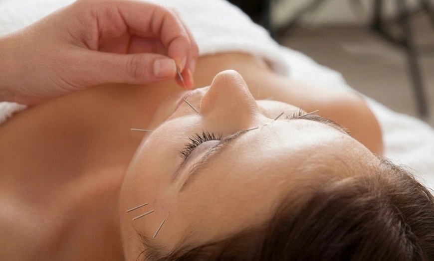 Image 4: Acupuncture Sessions for Pain Relief Stress and Wellness Care