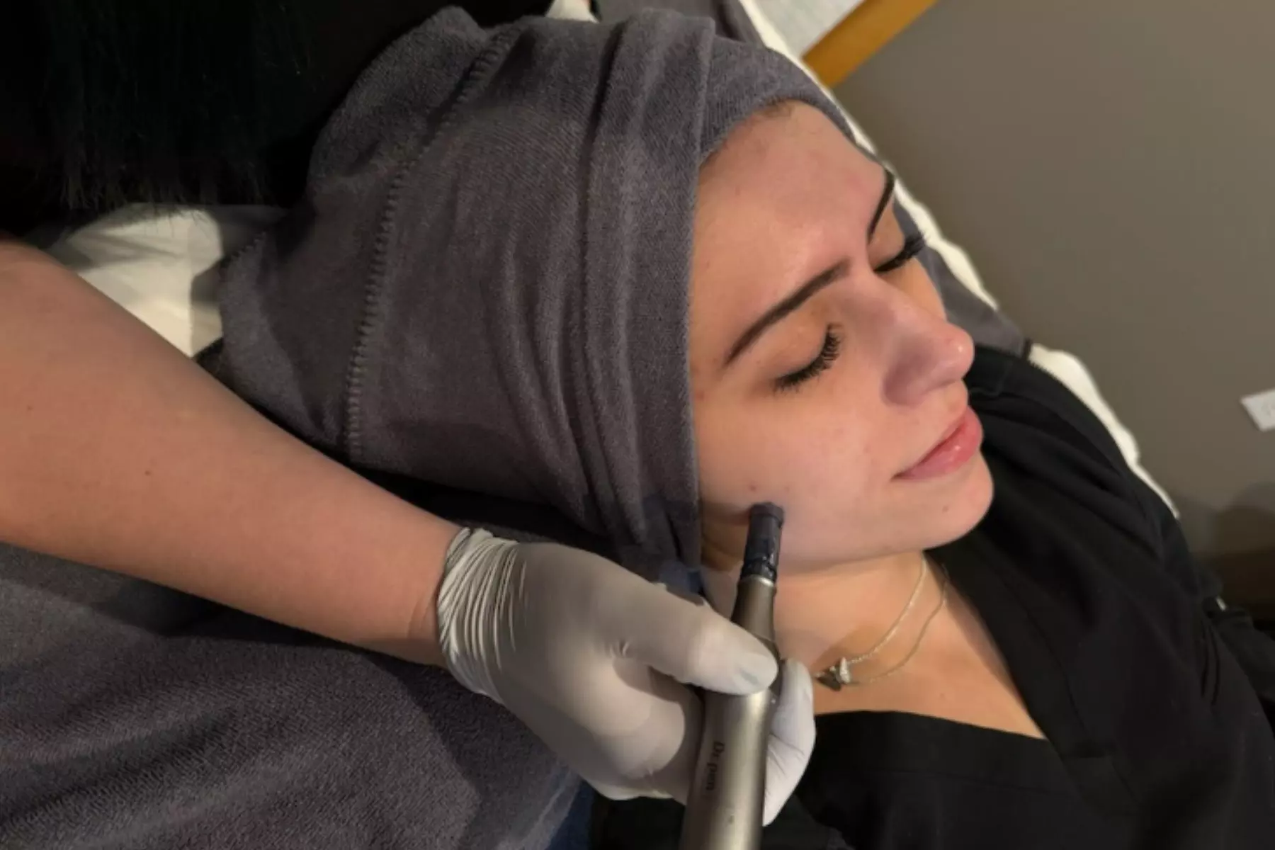 Reduce Fine Lines with One or Three DermaPen Microneedling Sessions