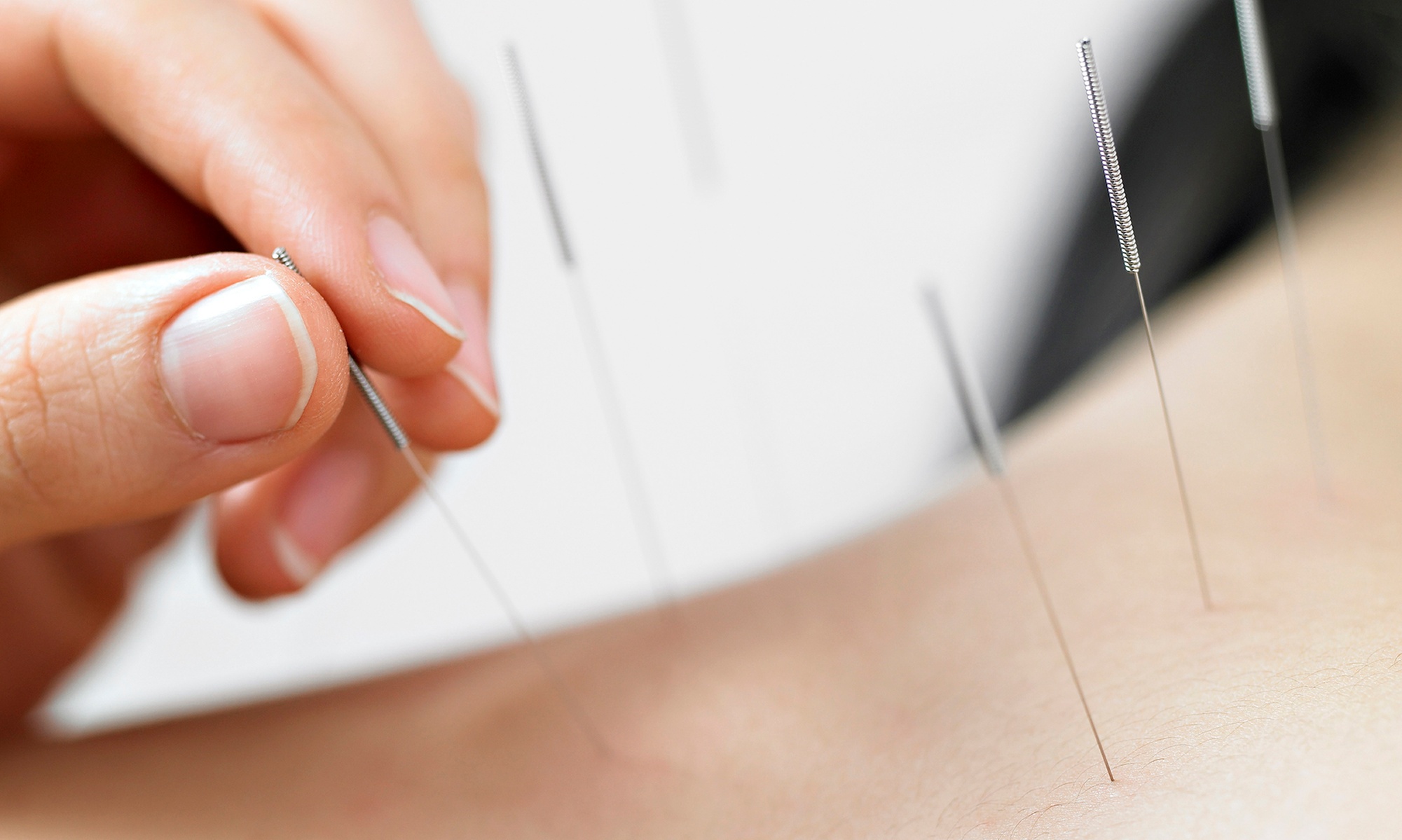 Up to 55% Off on Acupuncture at CALee Acupuncture