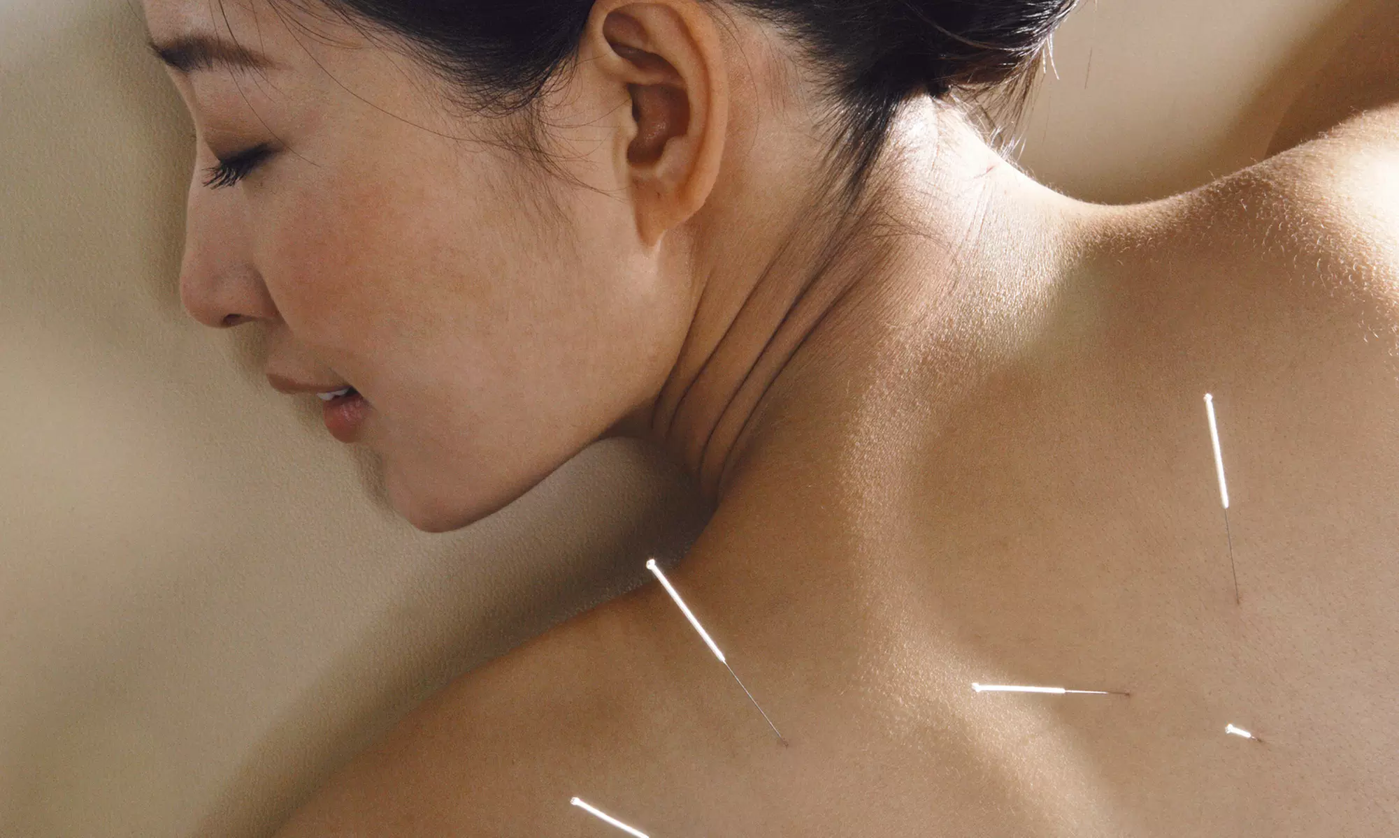 Acupuncture with Consultation at Acupuncture Family Practice (Up to 68% Off) - Primary Image