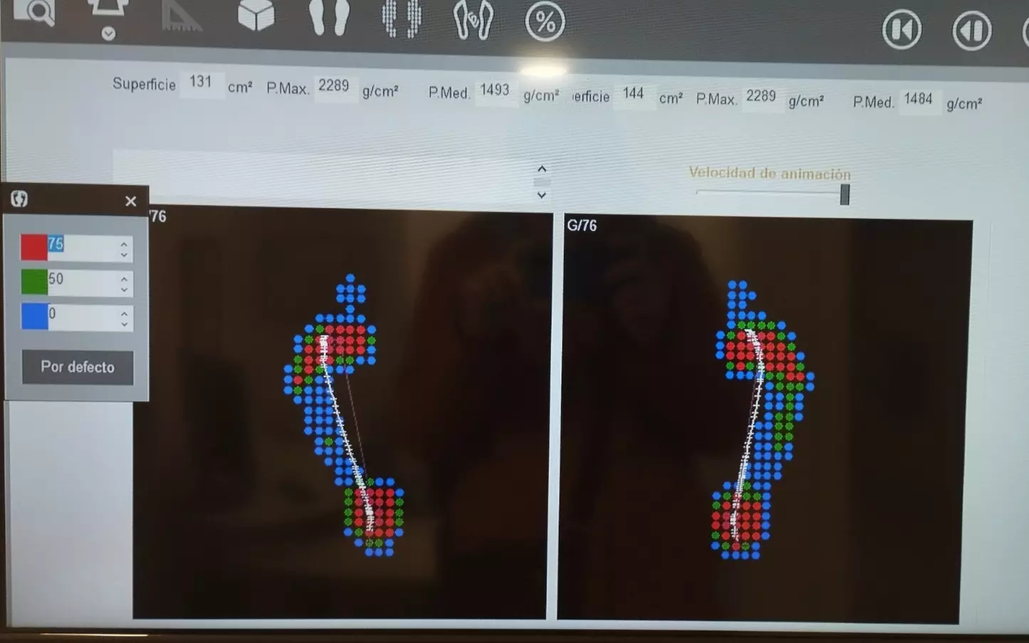 Estudio de la pisada en Centro Ortopédico de Pamplona Piñeiro