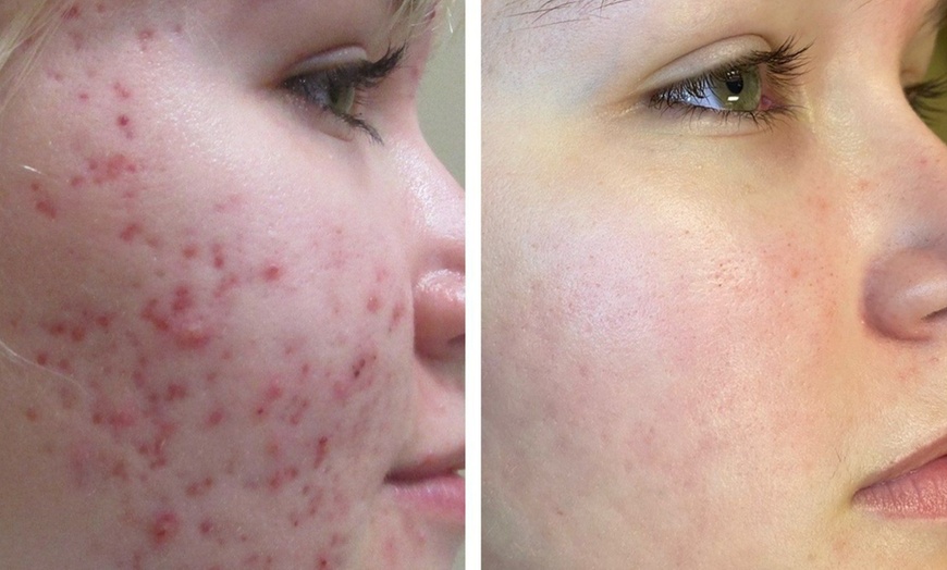 Image 3: HydroFacial with Dermaplaning and Microneedling