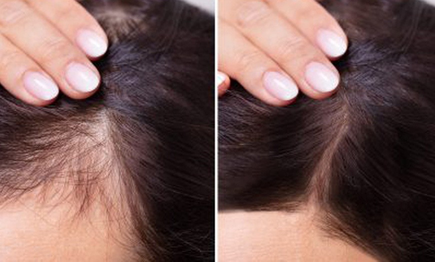 Image 6: Up to 71% Off on Hair Restoration - Other at London Hair Care Clinic