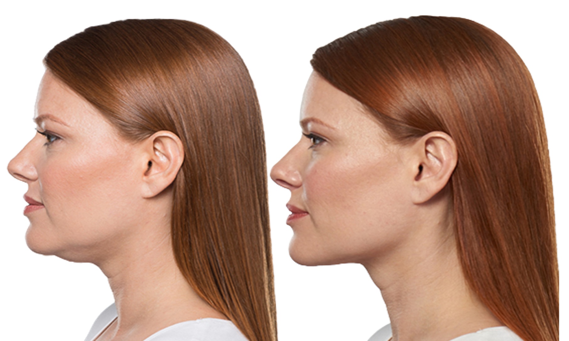 Sculpt Your Body: Mesotherapy for Fat Reduction and Cellulite!