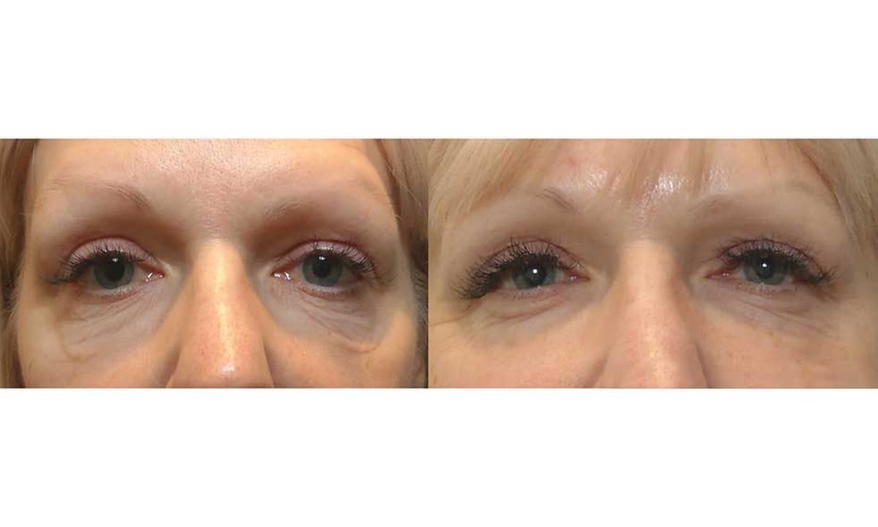 Radiant Skin with Morpheus8 RF Microneedling in Upper Darby, PA