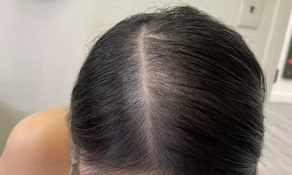 Scalp Micropigmentation Sessions for Various Hair Loss Levels