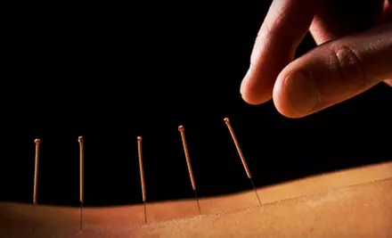 One or Three Acupuncture Sessions at Nicole Dunn, Acupuncturist & Holistic Therapist (Up to 55% Off) - Primary Image