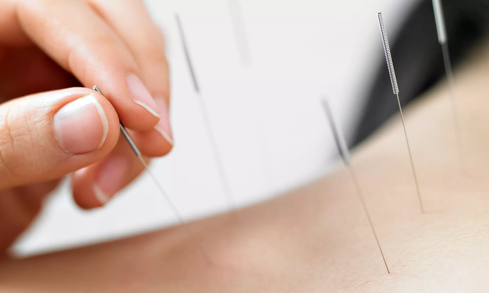 Two or Three 45-Minute Acupuncture Treatments and Initial Consultation at Classic Acupuncture (Up to 80% Off) - Primary Image