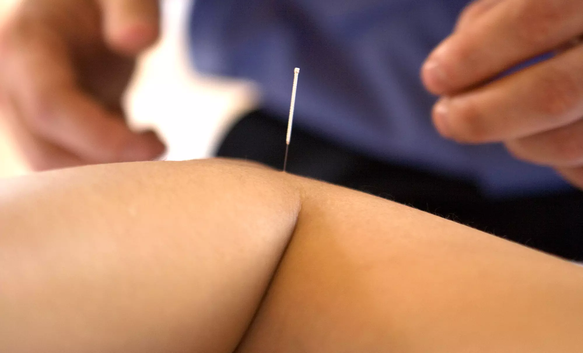 One or Three Acupuncture Treatments at Tucson Acupuncture Co-op (Up to 61% Off) - Primary Image
