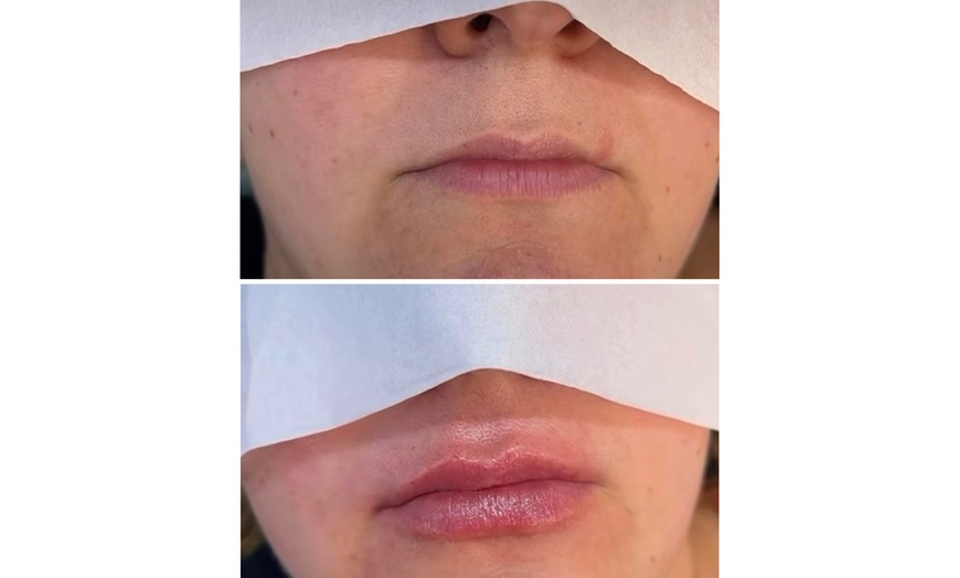 Image 4: Transform Smile: 0.5-, 1-, or 2-ml Dermal Filler or Dissolver & Refill