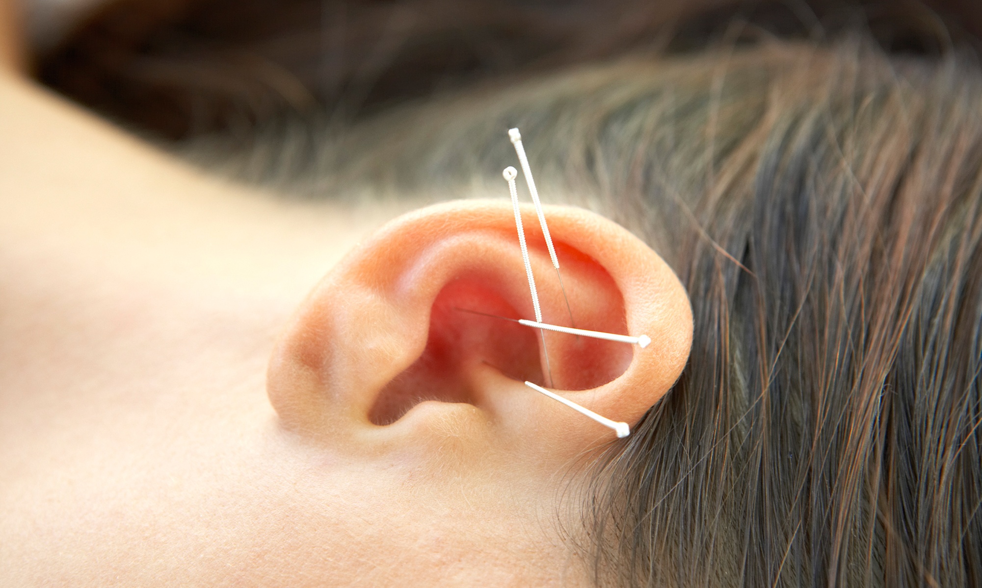 Try Acu-Thin Acupuncture Sessions for Weight Loss