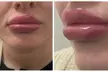 1ml or 2ml Dermal Lip Filler with Consultation at 4 Locations including Harley Street (Up to 74% Off) - Second Medium