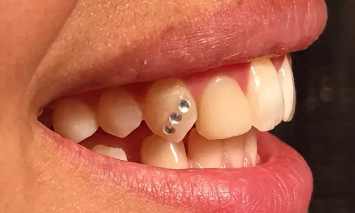 Geef je glimlach een schitterende upgrade met 1 of 4 Swarovski tandkristallen bij (tot 43% korting)