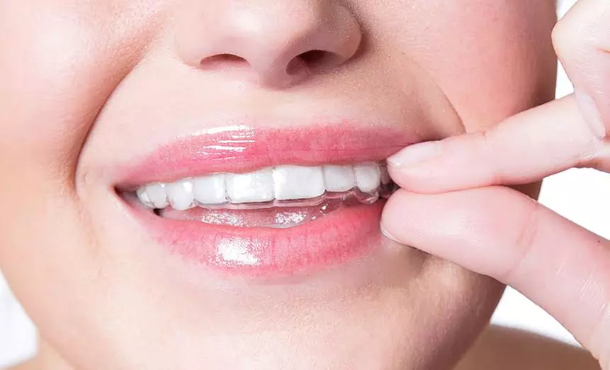 $59 for an Invisible Aligner Package from SmileDirectClub ($695 Value)     - Primary Image
