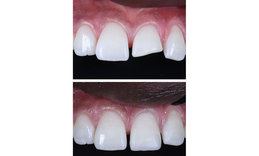 Image 1: Enhance Your Smile w/ Six, Eight, or Ten Teeth Composite Bonding Sess