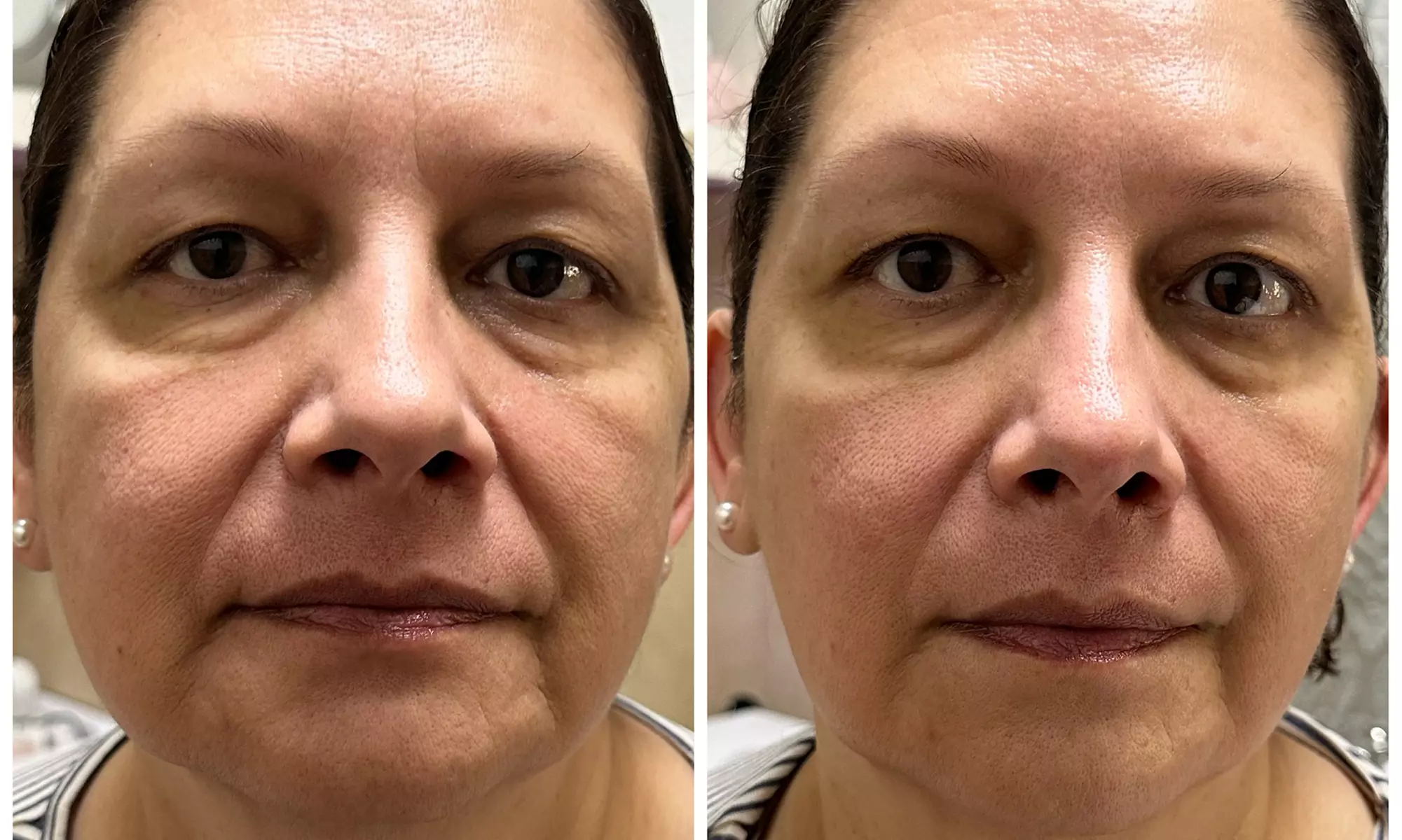 Clear Complexion Acne & Signature Facials for Radiant Skin