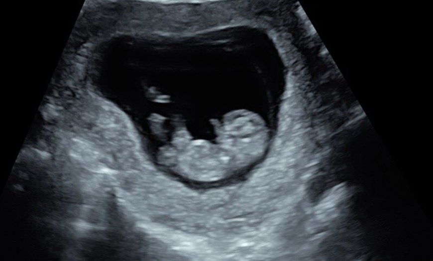 Image 1: Early Pregnancy Scan at Window To The Womb, Harlow