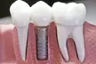Upgrade Your Smile with  Dental Implant with Consultation and Xray (£1,350 Off) - Second Medium