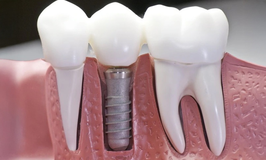 Image 3: Upgrade Your Smile with  Dental Implant with Consultation and Xray