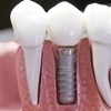 Image 3: Upgrade Your Smile with  Dental Implant with Consultation and Xray