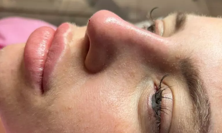 Choose the Perfect Lip Filler for You with 0.5ml or 1.1ml Lip Filler