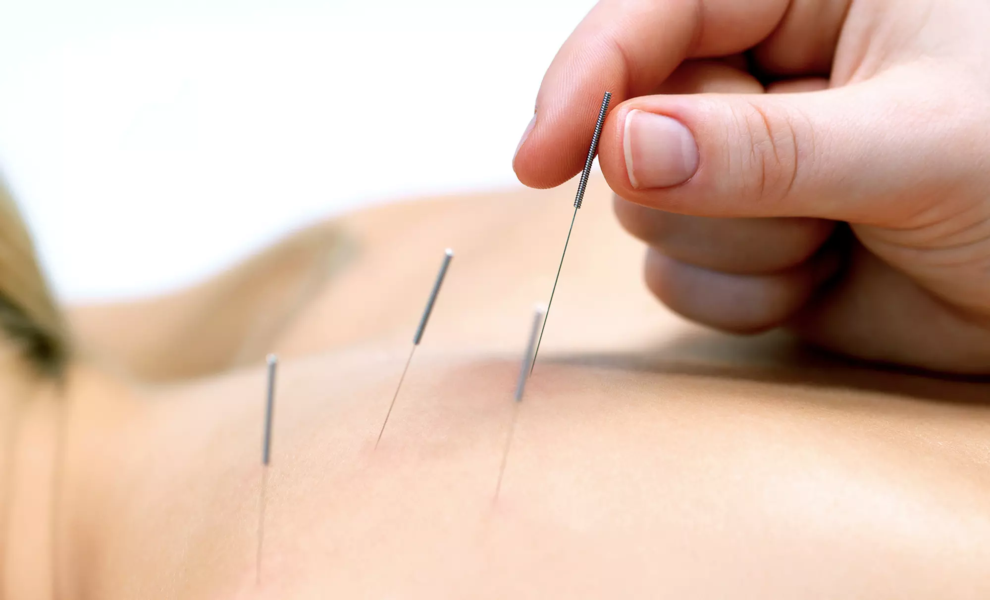 One or Three Acupuncture Treatments at Lifeline Acupuncture & Herbs Clinic (Up to 76% Off) - Primary Image