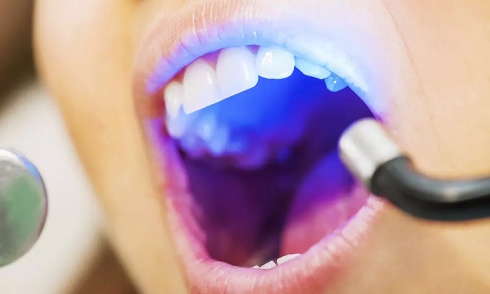 Una o dos sesiones de blanqueamiento dental Led con limpieza bucal y revisión desde 12,95 € en Dentimagen - Primary Image