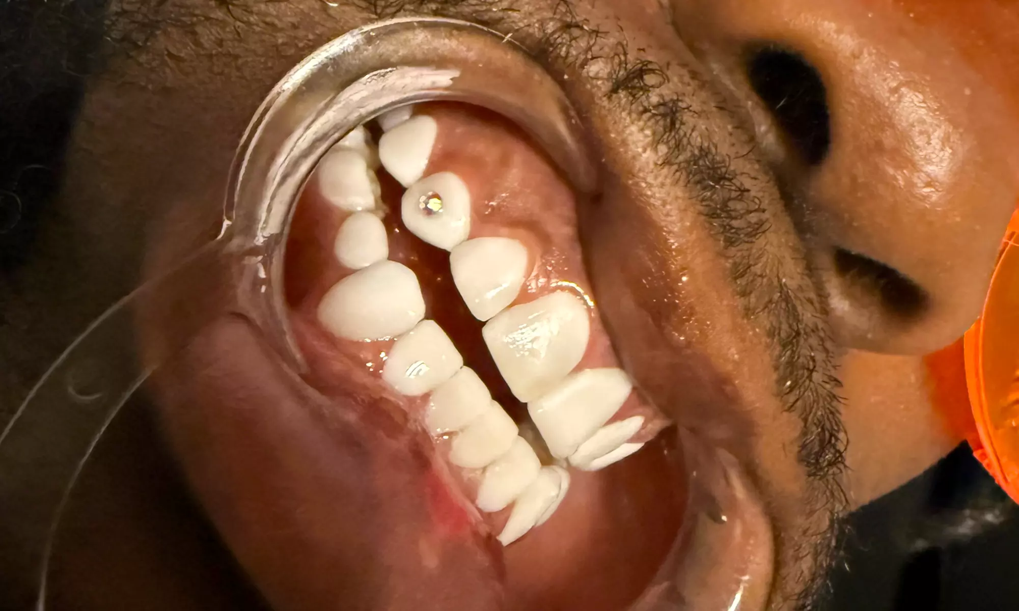 Tooth Gem Sparkle Application, Single or Double Tooth Gem and More