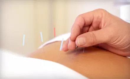 One or Three Acupuncture Treatments with Consultation at Wen Acupuncture Healing Center (Up to 73% Off) - Primary Image