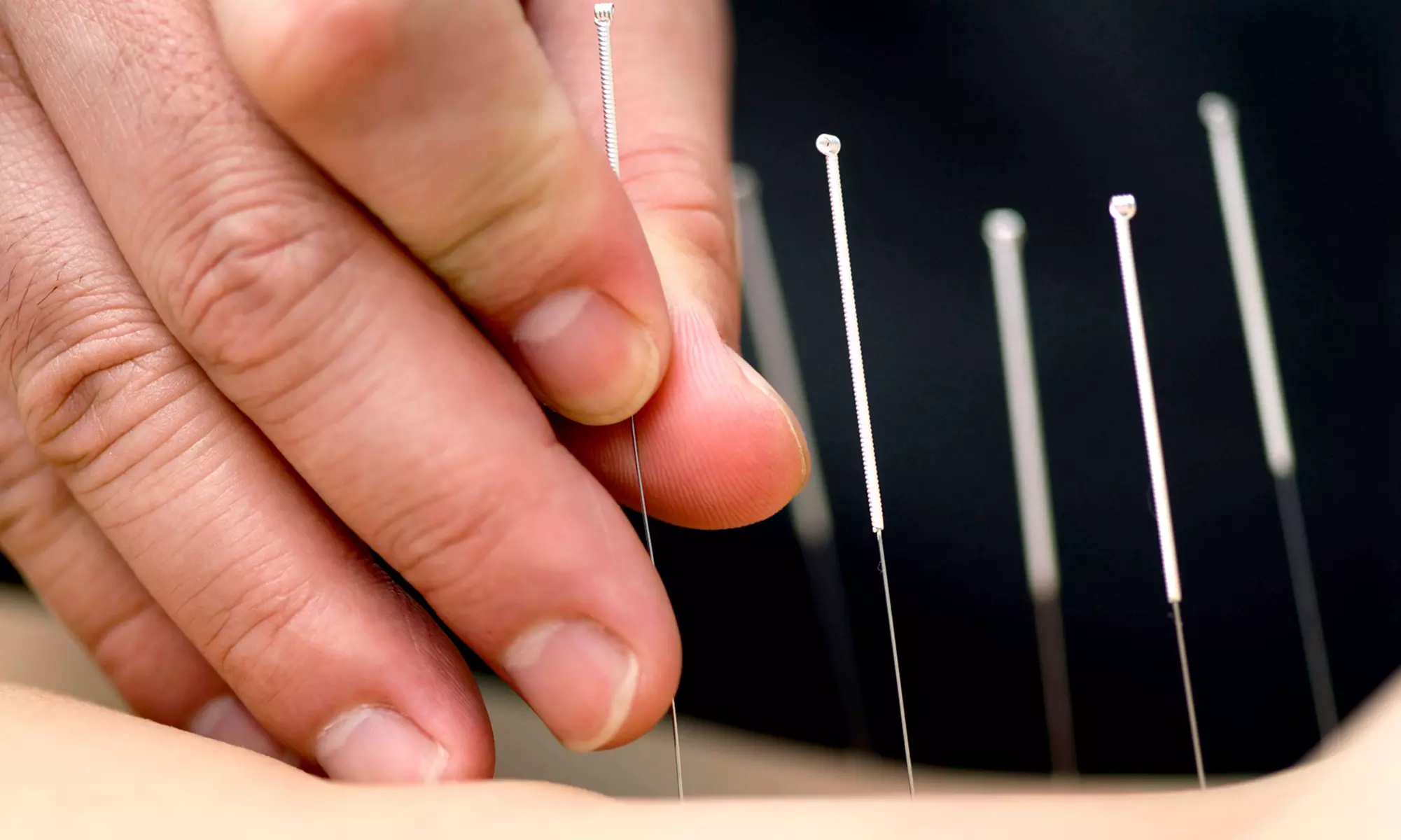 C$48 for Initial Assessment, Massage, and Acupuncture at University Traditional Chinese Medicine Clinic (C$190 Value) - Primary Image