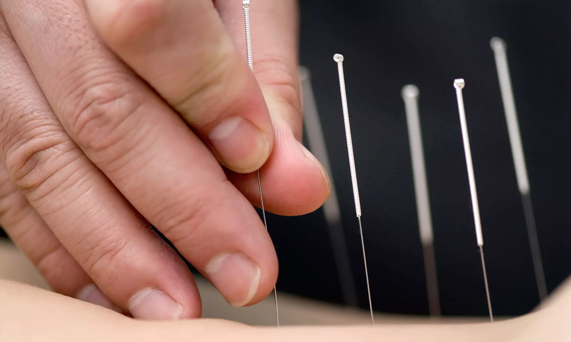 One or Three Acupuncture Sessions at Seattle Acupuncture and Coaching (Up to 71% Off) - Primary Image