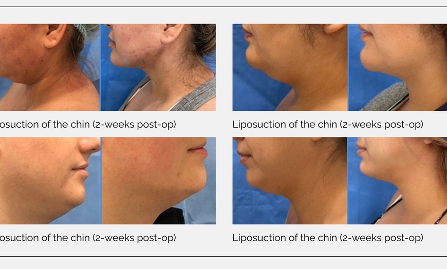 Image 1: Liposuction for Chin with Post Op Care Included. 