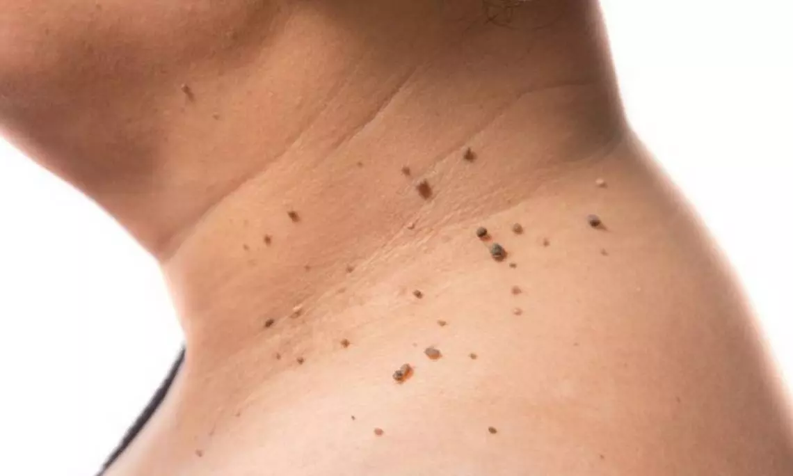 Say Goodbye To Skin Tags Effortlessly!