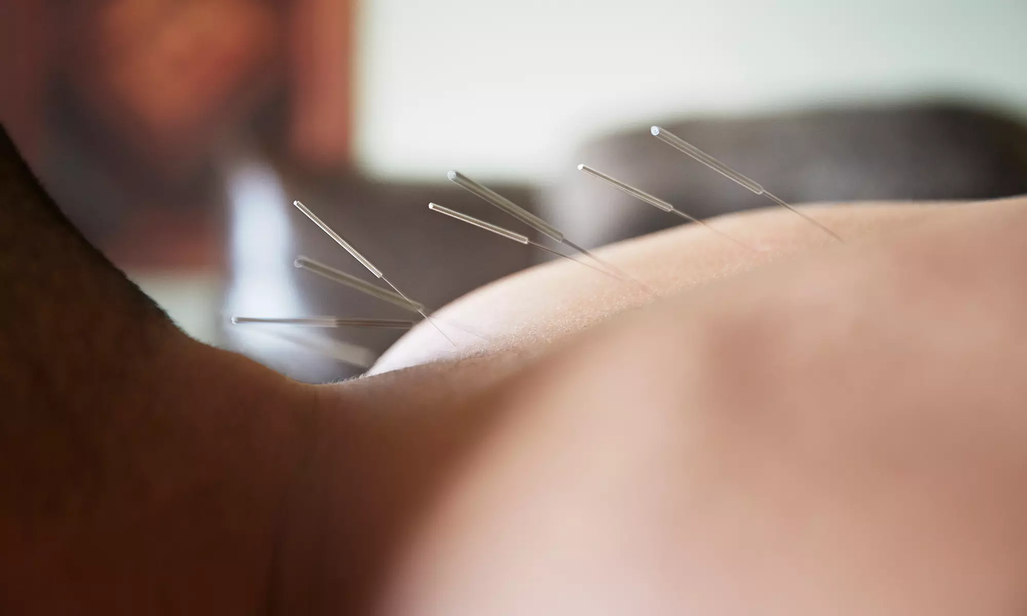 One or Three Acupuncture Treatments with Consultation from Joan Dedian at D'Arcy Wellness Center (Up to 78% Off) - Primary Image