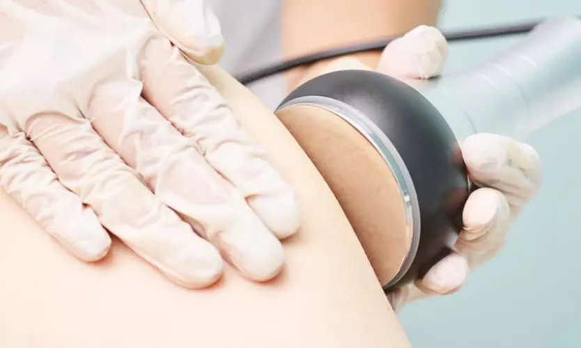 1 o 2 sesiones de radiofrecuencia corporal para 1 persona