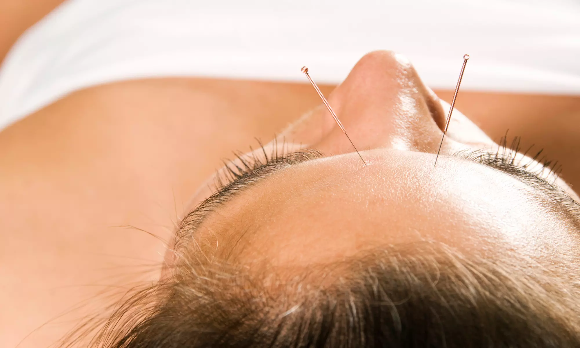 One, Two, or Three Acupuncture Sessions at 4 Winds Medicine (Up to 61% Off)  - Primary Image