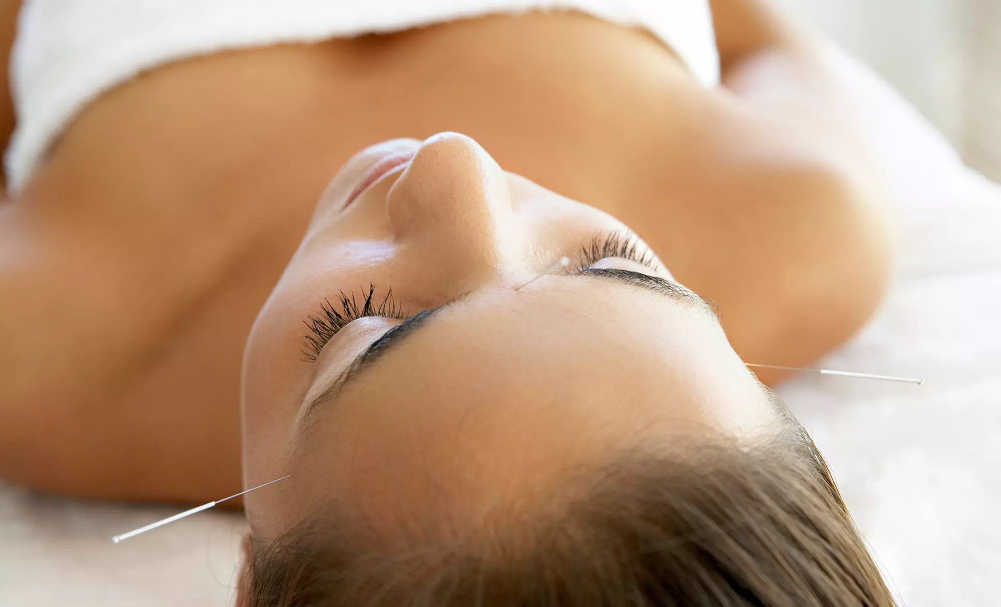 1 or 3 Acupuncture or Bach Flower Treatments at Natural Approach Wellness Center (Up to 58% Off) - Primary Image