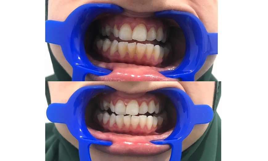 Image 5: Teeth Whitening Treatment