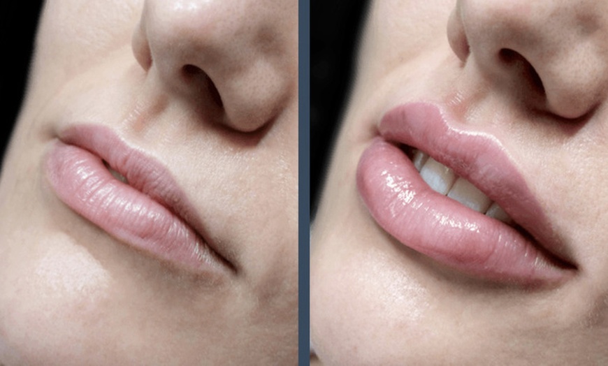 Image 3: Choose from Half Syringe, Full Syringe, or Lip + Tox Combo 