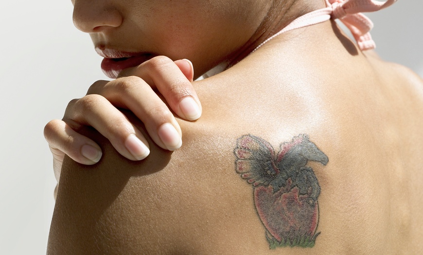 Tattoos and Tattoo Removal Better Together