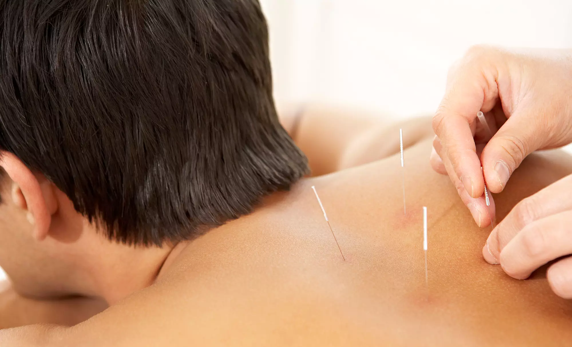 Discover Transformations' acupuncture and allergy techniques with up to 50% off for holistic health benefits - Primary Image