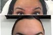 Maintain Youthful Skin: 20 or 40  Units of Jeuveau - Single or Three Sessions - Up to 50% Off - Second Medium